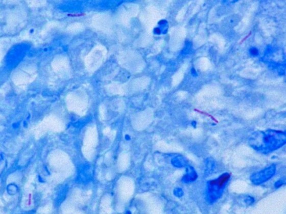 顯微鏡下的結核桿菌 Image courtesy of Wikipedia 