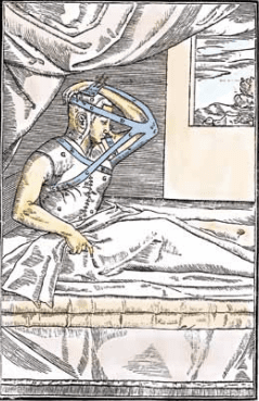 病人的手臂以藍 色的布條固定在臉上，讓皮膚組織有時間在鼻子周圍生長／塔利亞科齊，《移植手術糾正缺陷》（De  Curtorum Chirurgia Per Insitionem）插圖，西元1597年