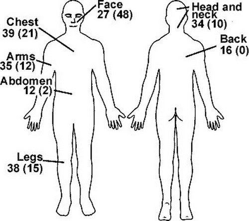 論文的研究顯示，橡皮子彈致傷通常在四肢和上半身。
