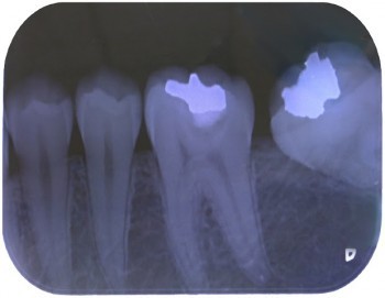 牙根掃描圖片。