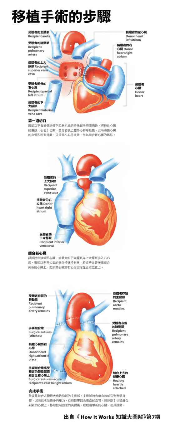 Heart transplants