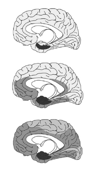 圖1.10　阿茲海默症的擴散。在初期（上圖）單單出現在海馬體區塊；中期（中圖）擴散到與海馬體相連接的大腦皮質區塊；後期（下圖）實際上擴及全腦。本圖出自《數位癡呆症》。