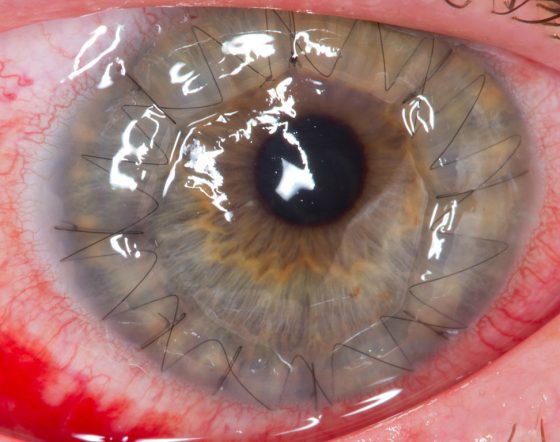 眼角膜移植。由於角膜和血管較無直接接觸，所以免疫排斥的影響比較小，加之手術比較簡單，所以發展的比腎臟移植早很多。from: wikimedia