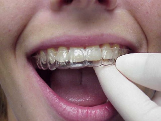 拆完牙套後，需長期帶著維持器，直到牙齒位置穩定。