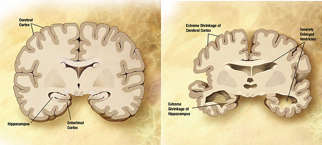 640px-Alzheimer's_disease_brain_comparison