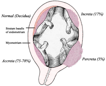 正常胎盤（Normal，左上）、沾連性胎盤（Accreta，左下）、植入性胎盤（Increta，右上）和穿透性胎盤（Percreta，右下）。圖／By TheNewMessiah, Public Domain, https://commons.wikimedia.org/w/index.php?curid=6367136