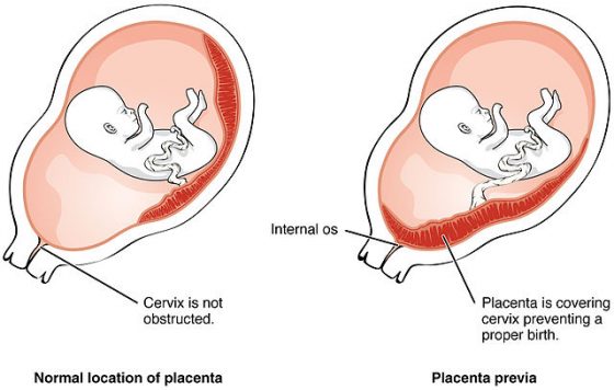 正常胎盤（左）與前置胎盤（右），前置胎盤生長的位置蓋住子宮頸，影響胎兒出生。圖／By OpenStax College, CC BY 3.0, https://commons.wikimedia.org/w/index.php?curid=30148588