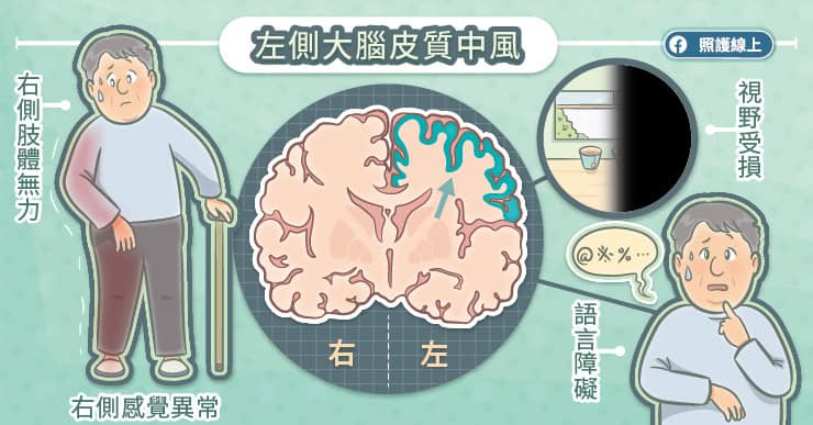 左側大腦皮質中風