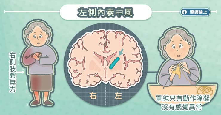 左側內囊中風