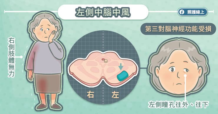 左側中腦中風
