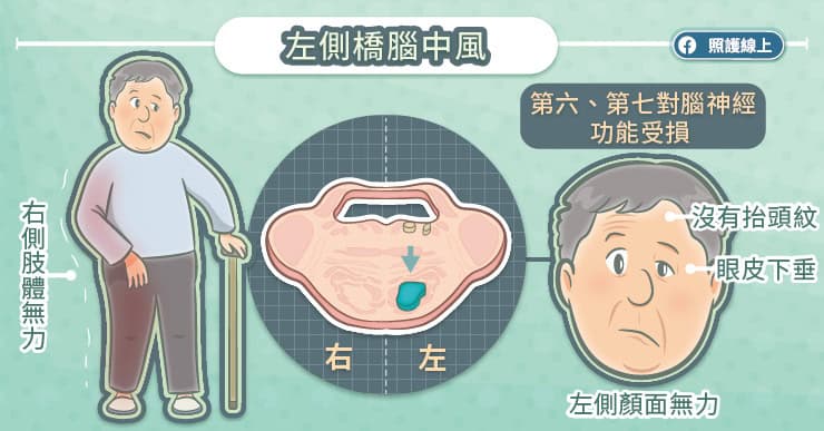 左側腦橋中風
