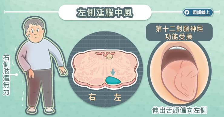 左側延腦中風