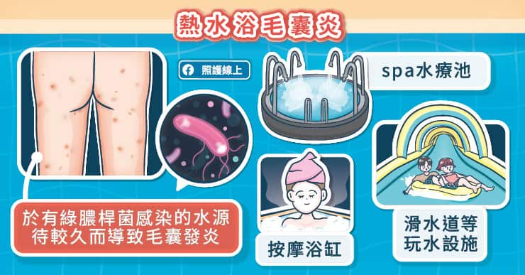 熱水浴毛囊炎