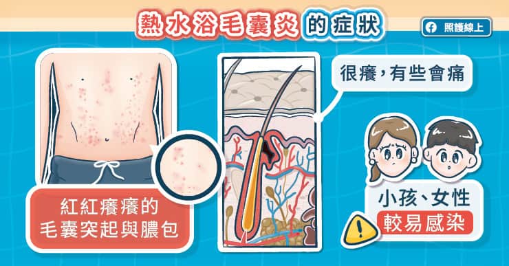 熱水浴毛囊炎的症狀