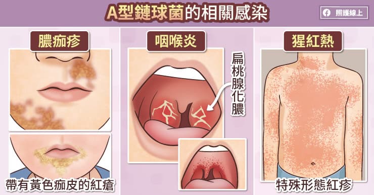 A型鏈球菌相關感染