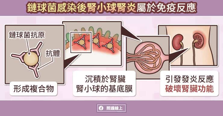 鏈球菌感染後腎小球腎炎屬於免疫反應