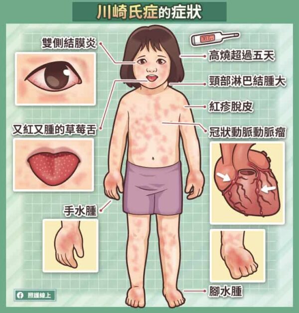 川崎氏症的症狀