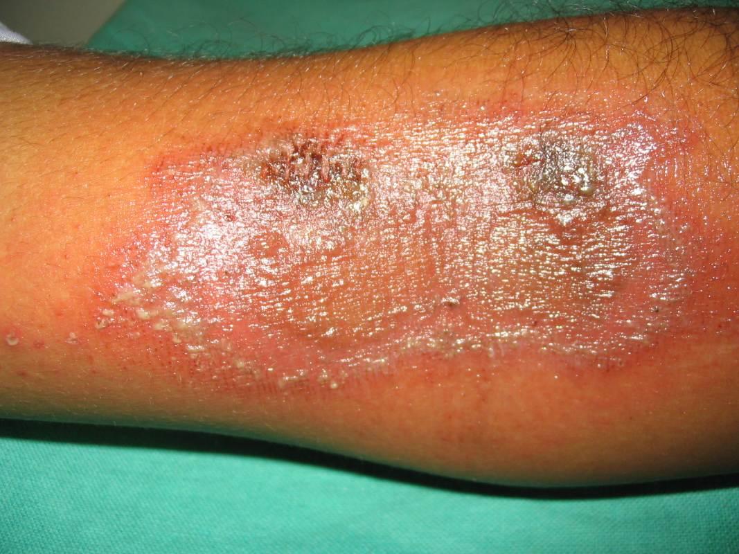 丘疹性荨麻疹（虫咬皮炎）持续恢复中，分享1个月抗疹经历 - 知乎