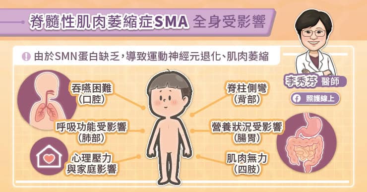 脊髓性肌肉萎縮症(SMA)全身受影響