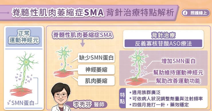 脊髓性肌肉萎縮症(SMA)背針治療