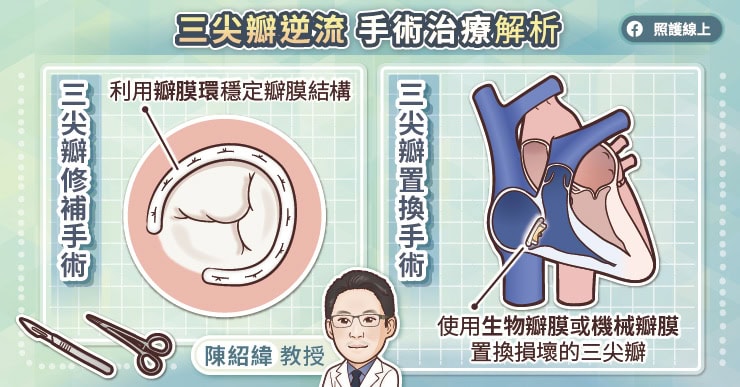 三尖瓣逆流手術治療